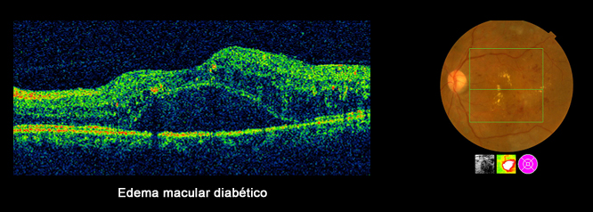 Retinoplastia