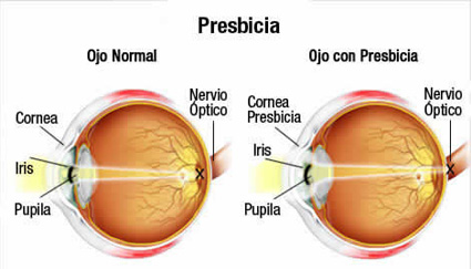 miopia astigmatismo hipermetropia y presbicia)